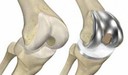 POR QUE É PRECISO PENSAR DUAS VEZES ANTES DE OPTAR PELA CIRURGIA DE PRÓTESE DO JOELHO?