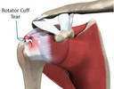 Ruptura completa do tendão supraespinhal melhora com fisioterapia?