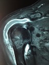 Ressonância com tendinopatia, ruptura parcial do supraespinhal e tendinite calcárea. Qual o tratamento? Tem cura? É grave?